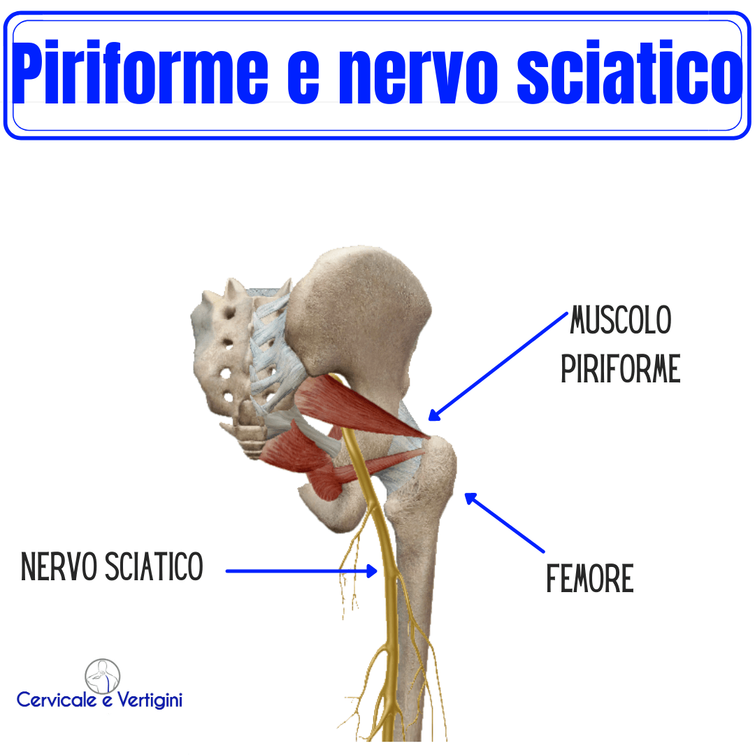 sindrome del piriforme