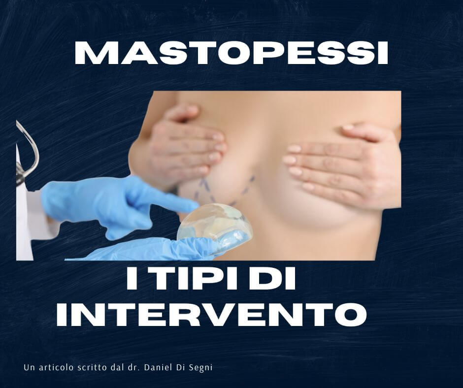 mastopessi intervento